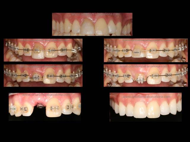 Foto 1 del artículo del Doctor Fernando de la Iglesia sobre Ortodoncia e Implantes y Estética Dental