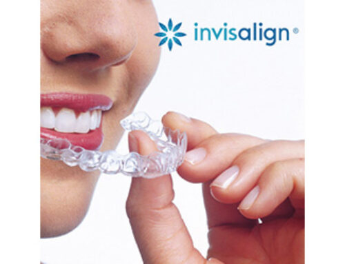 Mitos y verdades de Invisalign más frecuentes
