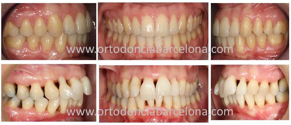 Foto 1 del artículo del Doctor Fernando de la Iglesia sobre Ortodoncia en pacientes con problemas de encía o Enfermedad Periodontal