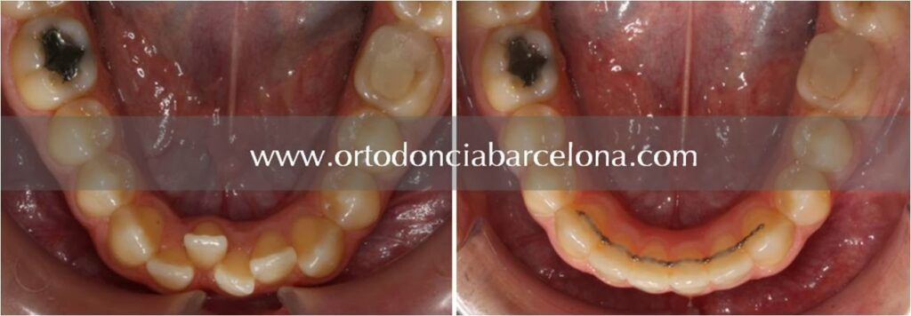 Foto 1 del artículo del Doctor Fernando de la Iglesia sobre Retención dental en ortodoncia