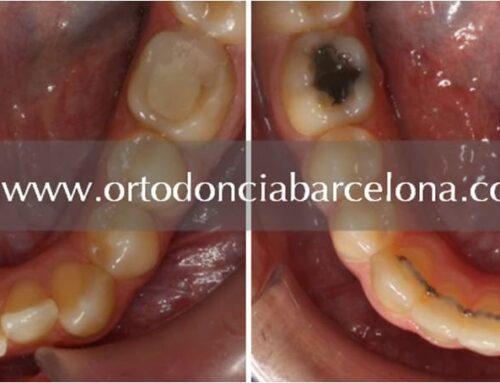 Retención dental en ortodoncia
