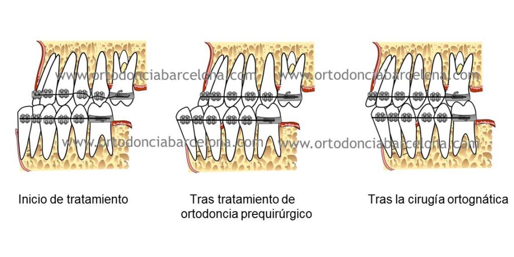 Foto 1 del artículo del Doctor Fernando de la Iglesia sobre Ortodoncia y Surgery First en Barcelona