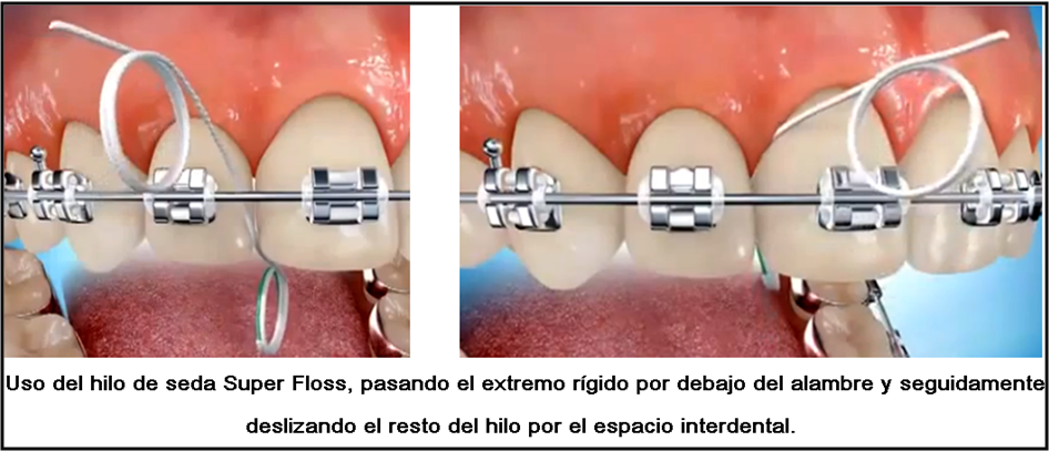 Foto 1 del artículo del Doctor Fernando de la Iglesia sobre Higiene y cuidados orales para pacientes con ortodoncia