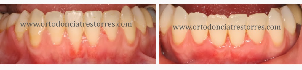 injertos-encia-ortodoncia