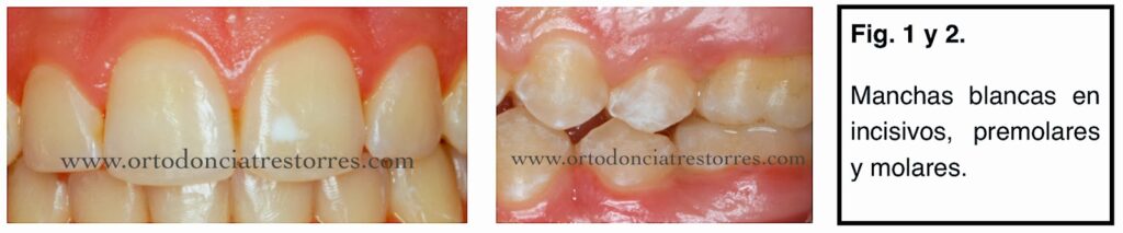 Foto 1 del artículo del Doctor Fernando de la Iglesia sobre Manchas blancas dentales. Causas y prevención. ¿La ortodoncia produce manchas blancas?