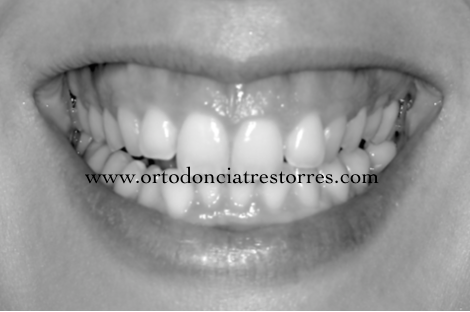 Foto 1 del artículo del Doctor Oriol Quevedo sobre ¿Qué es la SONRISA GINGIVAL? ¿Se puede tratar y corregir con ortodoncia?