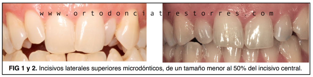 Foto 1 del artículo del Doctor Oriol Quevedo sobre Tratamiento de los incisivos laterales pequeños (Microdónticos y/o Conoides)