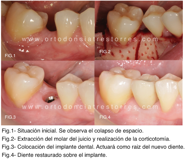 corticotomias-ortodoncia-barcelona