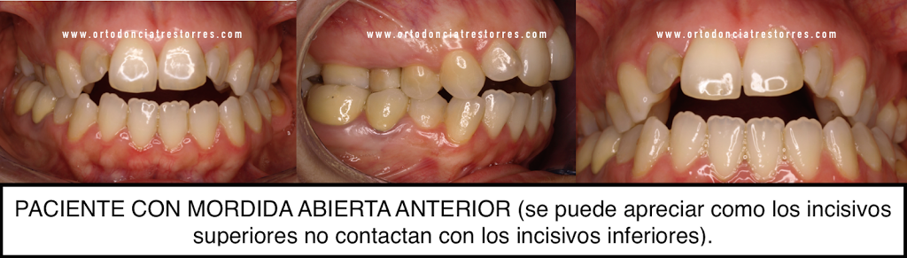 Foto 1 del artículo del Doctor Oriol Quevedo Pou sobre ¿Qué es una mordida abierta? ¿Cómo y por qué se produce? ¿Cómo se trata?
