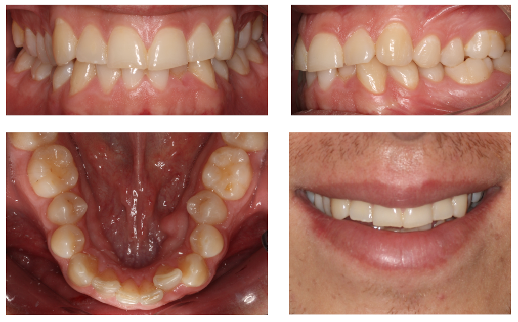 Foto 1 del artículo del Doctor Fernando de la Iglesia sobre Tratamiento de Ortodoncia Invisible mediante el sistema Invisalign en Barcelona