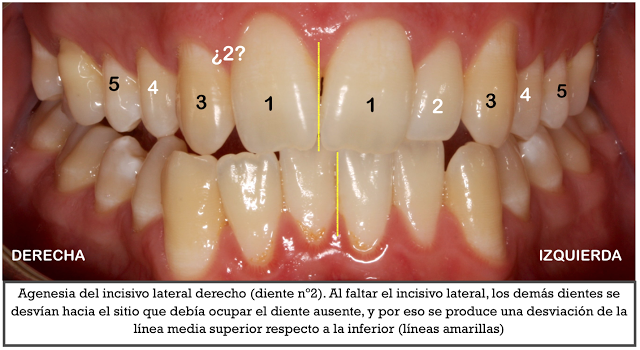 Foto 1 del artículo del Doctor Fernando de la Iglesia sobre Curso Agenesia dental