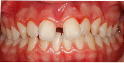 Foto 1 del artículo del Doctor Fernando de la Iglesia sobre Diastema y su tratamiento de Ortodoncia