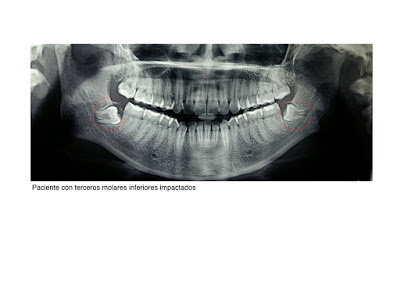 Foto 1 del artículo del Doctor Fernando de la Iglesia sobre Dientesretenidos o impactados y Ortodoncia
