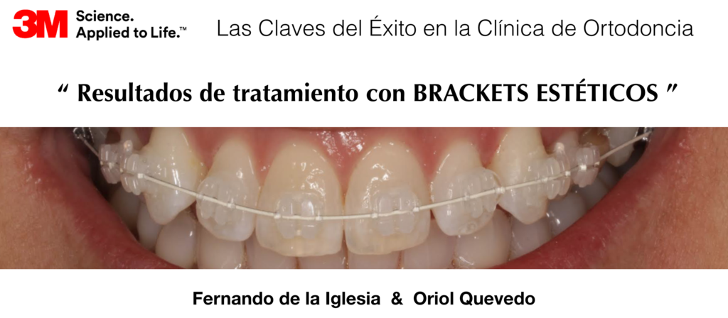 El Doctor Fernando de la Iglesia publica un artículo sobre “Las Claves del Éxito en la Clínica de Ortodoncia. Tratamiento con brackets estéticos"