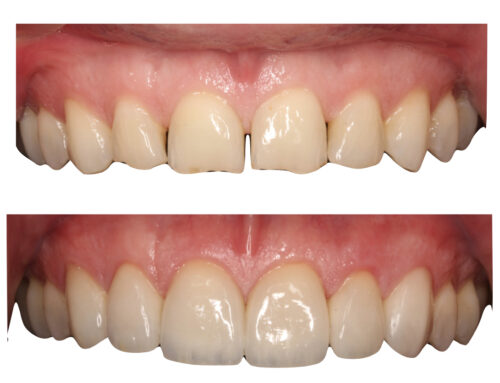 Estética dental y carillas de porcelana tras la ortodoncia