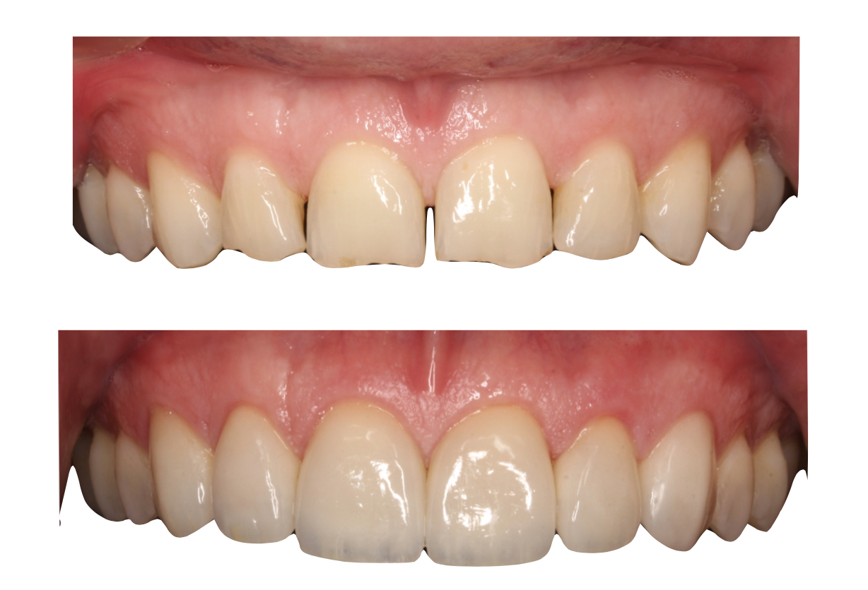Ejemplos de carillas dentales: antes y después