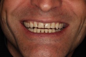 Sonrisa antes de la distribución de espacios con brackets para rehabilitar el frente anterior con carillas al final del tratamiento