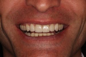 Sonrisa después de la distribución de espacios con brackets para rehabilitar el frente anterior con carillas al final del tratamiento