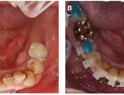 Enfermedad de encías ( periodontitis) y ortodoncia
