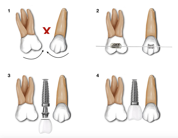 Secuencia que muestra un caso de ausencias dentales en la boca del paciente y la colocación de un implante después de ortodoncia ante 