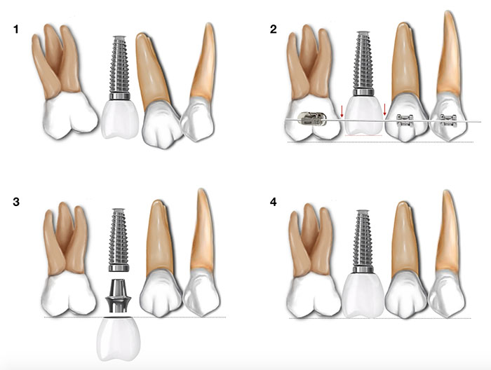 Secuencia que muestra un caso en el que el paciente presenta apiñamiento, ya es portador de un implante y del tratamiento de ortodoncia con implantes