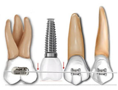 Ortodoncia con implantes
