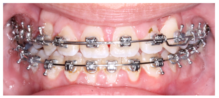 Imagen de la boca de un paciente con inflamación de encías por ortodoncia