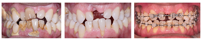 Imagen de la boca de un paciente con inflamación de encías, después de la fase higiénica previa a la ortodoncia y con control periodontal en el tratamiento