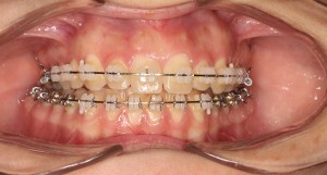 ortodoncia-trestorres-boca-brackets2