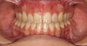 ortodoncia-trestorres-boca-final-tratamiento-brackets