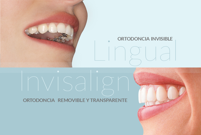 Existen dos tipos de ortodoncia invisible: Invisalign y lingual. Ven a visitarnos a Ortodoncia Tres Torres y diagnosticaremos la que mejor se adapta a ti