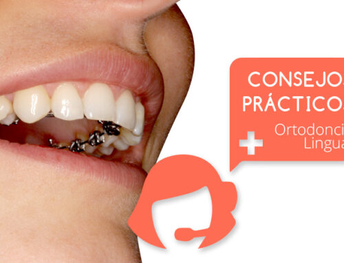 Consejos para los primeros días con ortodoncia lingual
