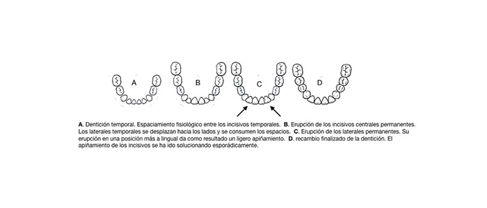 Fases de la erupción dentaria en los niños: dentición temporal, erupción de los incisivos centrales, erupción de los laterales y recambio finalizado