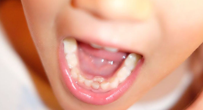 El recambio dentario en los niños empieza sobre la edad de los 6 años y dura hasta los 8 años