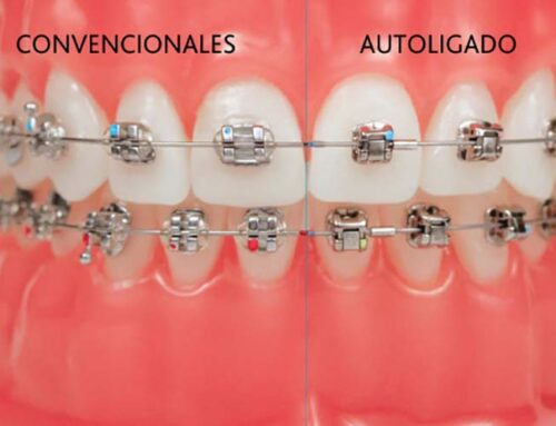 Brackets autoligables o convencionales