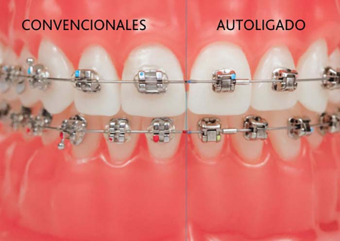 Hay dos tipos de brackets, los brackets autoligables y los brackets convencionales, cada uno con sus ventajas para un tratamiento de ortodoncia
