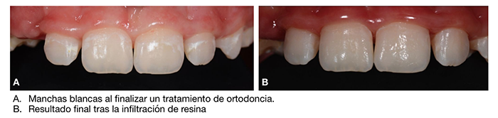Durante la ortodoncia una mala higiene puede provocar manchas blancas en los dientes por brackets