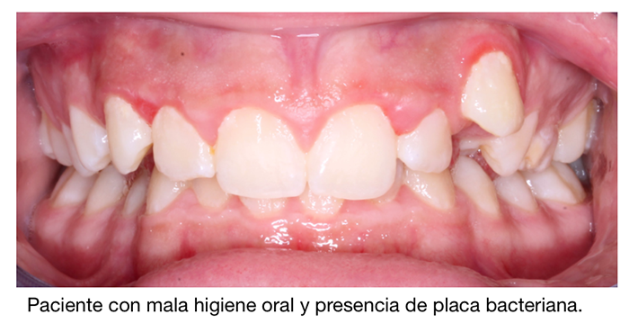 Durante la ortodoncia la mala higiene oral provoca la aparición de placa bacteriana