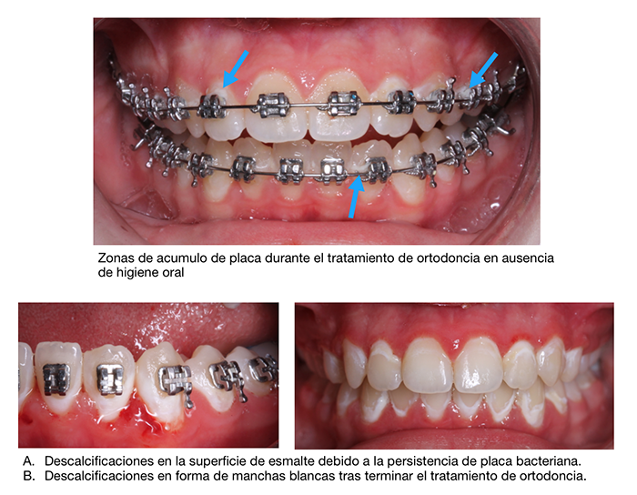 Durante la ortodoncia una mala higiene puede provocar manchas blancas en los dientes por brackets
