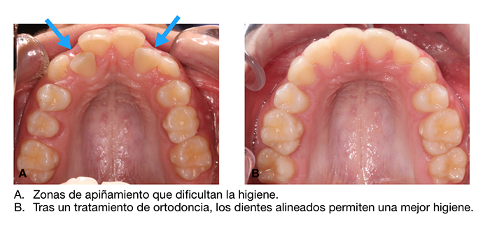 Con la ortodoncia se consigue mejor higiene oral ya que una vez alineados los dientes se pueden cepillar de forma más sencilla