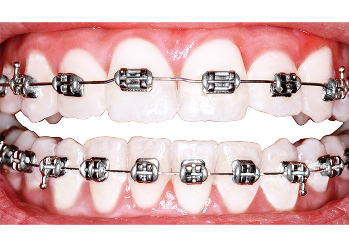 En ortodoncia con brackets, los brackets tienen una información específica que se expresa a través del arco