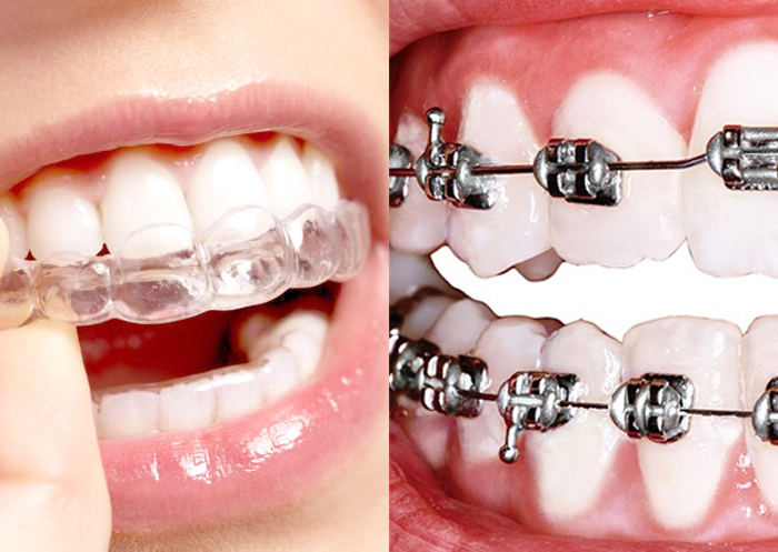 ◦ La ortodoncia mixta consiste en combinar brackets y alineadores, o lo que es lo mismo, brackets e Invisalign