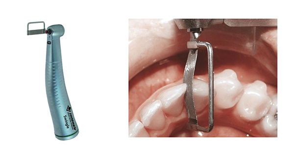 Utilización de las limas rotatorias de stripping dental para conseguir mayor reducción interproximal 