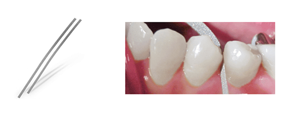 Utilización de las tiras de stripping dental para romper el punto de contacto entre los dientes sin necesidad de conseguir mucha reducción de espacio