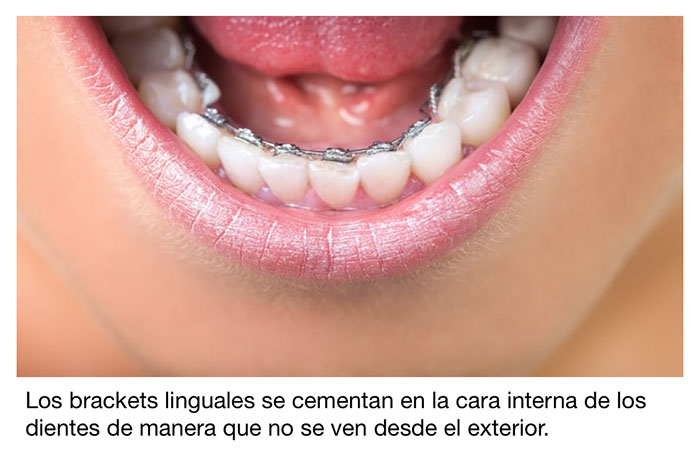 Imagen de un aparato lingual colocado en la cara interna de los dientes