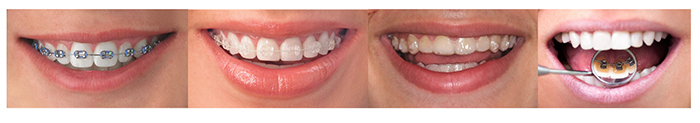 Imagen con las técnicas de ortodoncia, de izquierda a derecha: aparatos metálicos, brackets de cerámica, Invisalign y técnica lingual de ortodoncia