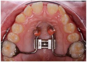 Imagen de un expansor de paladar anclado sobre 2 microtornillos anteriores y sobre bandas en los molares