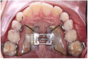Imagen de un expansor de paladar fijo cementado en los molares superiores