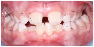 Imagen de una mordida cruzada bilateral en la que los dientes superiores quedan por dentro de los inferiores en ambos lados