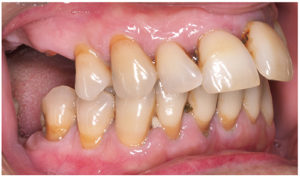 Imagen de una dentadura con enfermedad periodontal en la que se observa la posición e inclinación más adelantada de los incisivos.